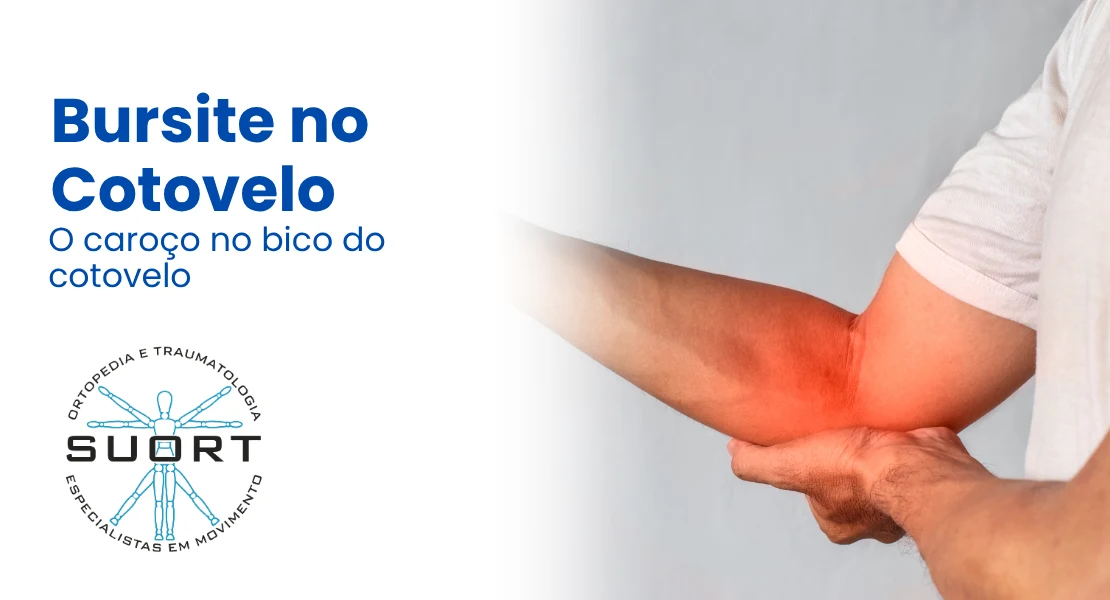 Bursite no cotovelo (olecraniana), tratamento do caroço no cotovelo com ortopedista com convênio em Perdizes, São Paulo