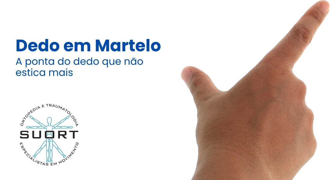 Dedo em martelo (mallet finger), tratamento com tala e ortopedia da mão com convênio em Perdizes, São Paulo