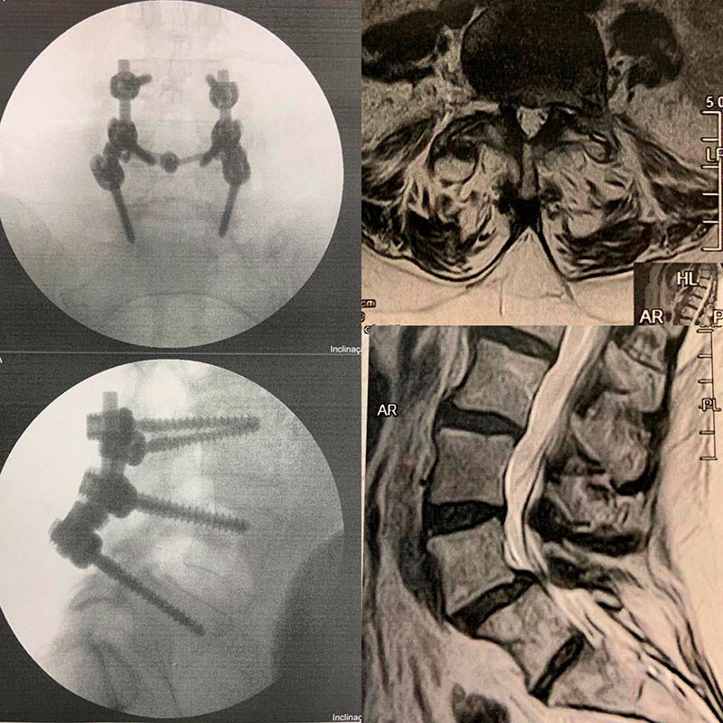 Paciente idosa com estenose de canal lombar provocada por espondilolistese e sintomatologia de clássica claudicação neurogênica. Foi submetida a descompressão do canal através de laminectomia L4/L5 e L5/Vt, além de estabilização segmentar com a colocação de parafusos pediculares para artrodese