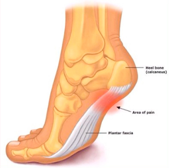 Fascite Plantar