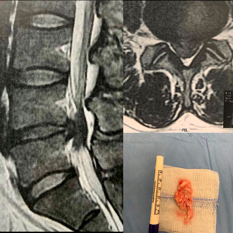 Hérnia de disco lombar L4/L5 removida através de microdiscectomia